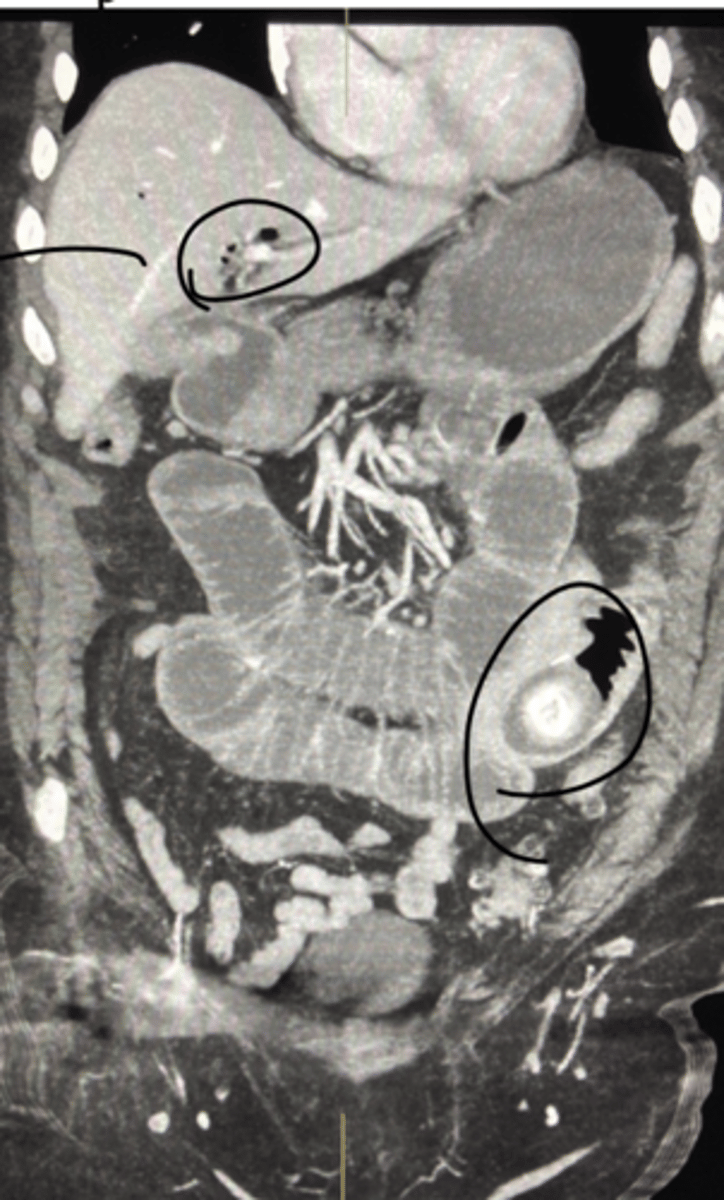 <p>Define Cholelithiasis Complication:</p><p>Gallstone obstructs small bowel</p><p>-Path:</p><p>&gt; Cholecystits w/ fistual between gallbladder &amp; small bowel --&gt; stone enters GI lumen ==&gt; OBSTRUCTION at ILEOCECAL VALVE (narrowest point)</p><p>&gt; Pneumobilia (air in biliary tree) = Fistula --&gt; AIR from intestine fills biliary tree</p><p>-Dx: Imaging (XRAY)</p><p>&gt; Rigler Triad = Pneumobilia, SBO, Gallstone outside gallbladder (ectopic)</p>