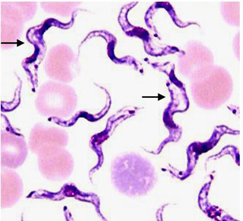 <p><strong>1. Identify the parasitic stage, and mention the disease caused by this parasite.</strong><br>→ <em>Polymorphic trypomastigotes</em><br>→ Disease: <strong>African trypanosomiasis (sleeping sickness)</strong></p><div data-type="horizontalRule"><hr></div><p><strong>2. Mention the stain used in this blood smear.</strong><br>→ <strong>Giemsa stain</strong></p><div data-type="horizontalRule"><hr></div><p><strong>3. Mention two diagnostic samples for detecting this parasite.</strong><br>→ - Chancre aspirate for Thick blood or buffy coat smears<br>→ - Lymph node aspirate, bone marrow, or cerebrospinal fluid (CSF)</p><div data-type="horizontalRule"><hr></div><p><strong>4. List haematological findings in this infection.</strong><br>→ - Anaemia and thrombocytopenia<br>→ - Moderate leukocytosis<br>→ - High levels of immunoglobulins, mainly IgM</p><div data-type="horizontalRule"><hr></div><p><strong>5. Mention the pathognomonic immune cell in CSF in this infection.</strong><br>→ <strong>Morula cell of Mott</strong></p>