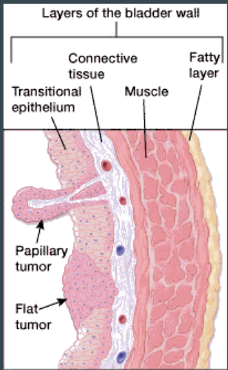 <ol><li><p>Papilary (Ta)</p></li></ol><ul><li><p>finger like projecitons that grow from inner surface towards hollow part of bladder</p><ul><li><p>do no grow deep into muscle layers</p></li><li><p>non-invasive, slow growing tumors</p></li><li><p>tend to have good outcomes</p></li></ul></li></ul><ol start="2"><li><p>Flat (Tis)</p></li></ol><ul><li><p>do not grow towards the hollow area of bladder, and are only found on the surface of the bladder</p><ul><li><p>high recurrence rate</p></li></ul></li></ul><p></p>