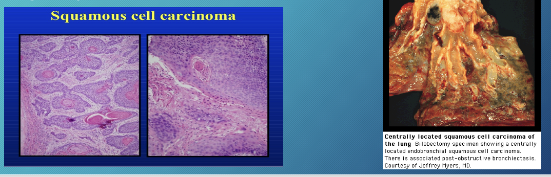 <p>2nd most common form of non-small cell carcinoma</p><p>found in smokers</p><p>associated with hypercalcemia and hypertrophic osteoarthropathy</p><p>less likely to metastasize than adenocarcinoma</p><p>centrally located and can cavitate</p><p></p>