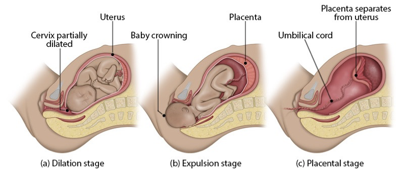 <ul><li><p>to expel baby from uterus</p></li><li><p>contractions less strong than during transitional stage; controllable</p></li><li><p>contracts last around 1 min, every 1-3 mins (variable)</p></li><li><p>generally 30 min-2 hrs w/ first baby, usually shorter in subsequent births</p></li><li><p>active pushing helps move fetus thru birth canal</p></li><li><p>crowning (baby’s head visible at vaginal opening) → birth is near</p></li><li><p>baby usually emerges face down, then rotates to align shoulders</p></li><li><p>final pushes completely deliver baby</p></li><li><p>stage 2 of parturition</p></li></ul><p></p>