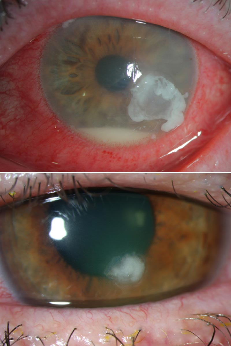 <p>PP: ulcer in cornea→diffuse conjunctival injection</p><p>E: abrasions<br>injuries<br>viral<br>bacterial</p><p>CM: moderate-severe+superficial pain<br>decreased vision<br>watery/purulent discharge<br>pupil not affected (unless iritis develops)<br>infection→corneal opacity+epithelial defect</p><p>DX:<br>focal white opacity+staining: epithelia defect+underlying hazy white infiltrate</p>