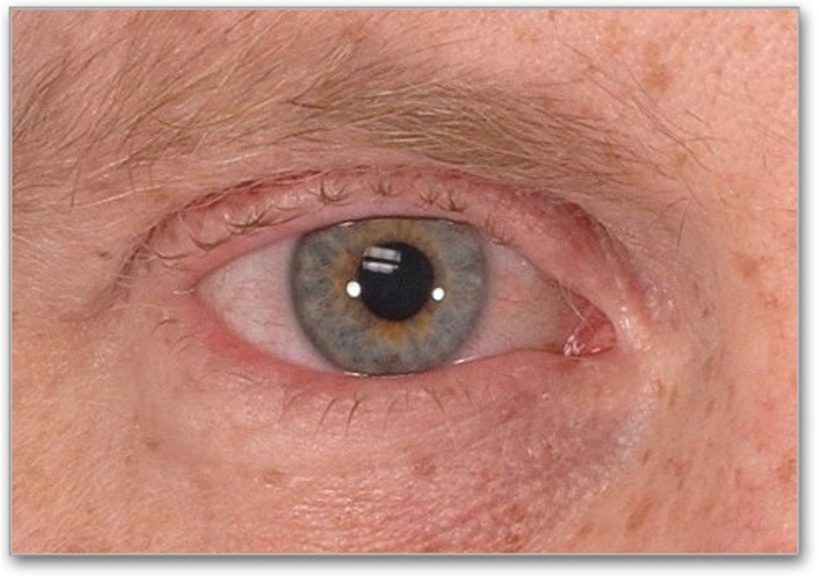 <p>chronic bilateral dry eyes and dry mouth</p>