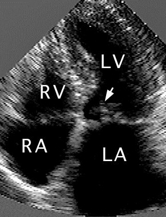 <p><span>The patient in the apical echocardiographic view above is a 20 year old male with a history of unexplained deaths due to cardiac arrest in his family.&nbsp; He has no history of hypertension.&nbsp; What is the most likely diagnosis? </span></p><p></p><p>constricitve pericarditis</p><p></p><p>restrictive cardiomyopathy</p><p>&nbsp;</p><p>dilated cardiomyopathy</p><p>&nbsp;</p><p>hypertrophic cardiomyopathy</p>