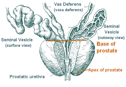 <p>The prostate:</p><p>A. develops from the urogenital sinus T</p><p>B. has no muscle in its structure F</p><ul><li><p><strong>prostate contains smooth muscle fibers</strong> within its stroma. These muscle fibers play a role in <strong>expelling prostatic secretions during ejaculation</strong>.</p></li></ul><p>C. has a plexus of veins inside its own capsule F</p><ul><li><p><strong>prostatic venous plexus is not located inside the capsule</strong>. Instead, it is found <strong>around the capsule of the prostate</strong>, forming a dense network that drains into the internal iliac veins.</p></li></ul><p>D. contains the widest part of the urethra T</p><p>E. is the homologue of the urethral glands (Skene's tubules) in the female T</p>