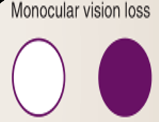 <p><u>Mono</u>cular vision loss</p>