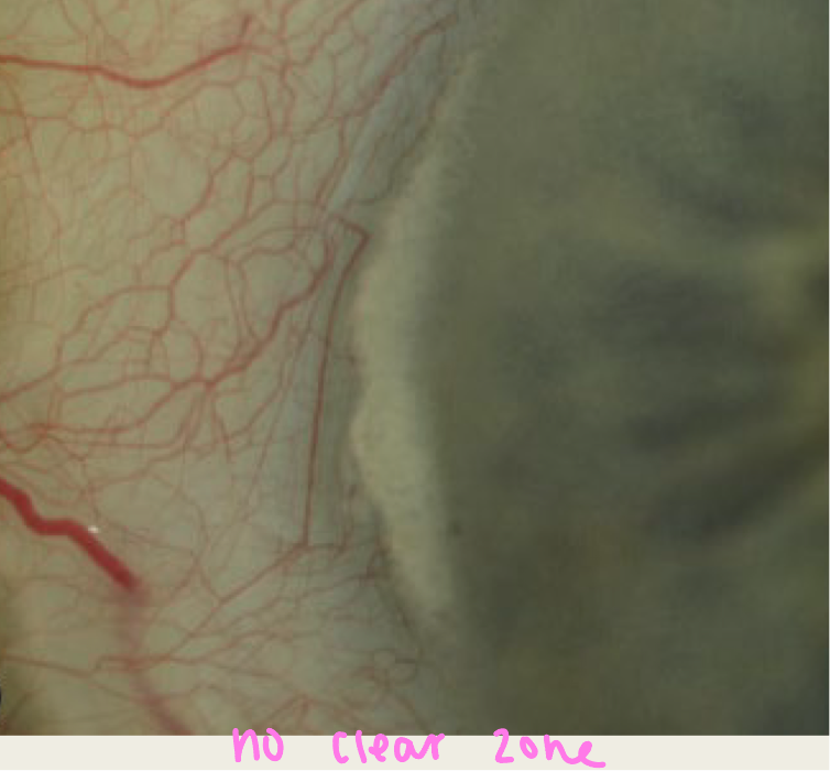 <ul><li><p>common peripheral corneal opacity</p></li><li><p><span><strong>Onset</strong>: elderly individuals</span></p><ul><li><p><span>Found in 60% of individuals over the age of 40</span></p></li></ul></li><li><p><span><strong>Symptoms</strong>: asymptomatic</span></p></li><li><p><span><strong>Presentation</strong>: whitish crescentric limbal bands made up of <em>chalk</em> like flecks</span></p><ul><li><p><span>Occurs at 9 and/or 3 o’clock</span></p></li><li><p><span>More common <em>nasal</em>, can go temporal</span></p></li><li><p><span>May present with <em>holes</em> within the lesion; gives “swiss cheese” appearance</span></p></li></ul></li><li><p><span><strong>Treatment</strong>: none</span></p></li></ul><p></p>