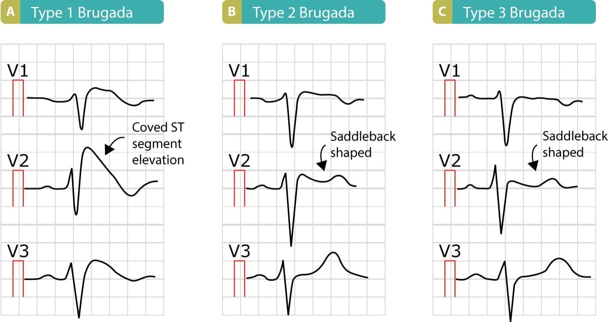 <p><strong>ECG: Look in leads V1–V3</strong></p><ul><li><p class=""><strong>Type 1 Brugada</strong>: Coved ST elevation ≥2 mm in ≥1 of V1–V3 <strong>followed by an inverted T wave</strong></p></li><li><p class="">Type 2 or 3 are "saddle-back" patterns (less diagnostic)</p></li><li><p class=""></p></li></ul><p></p>