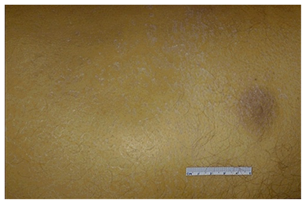 <p>Where is the easiest site to detect icterus/jaundice?</p>