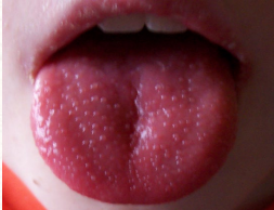 <p>a complication of GABHS pharyngitis/tonsilitis characterized by a strawberry tongue, fine “sandpaper” rash</p>