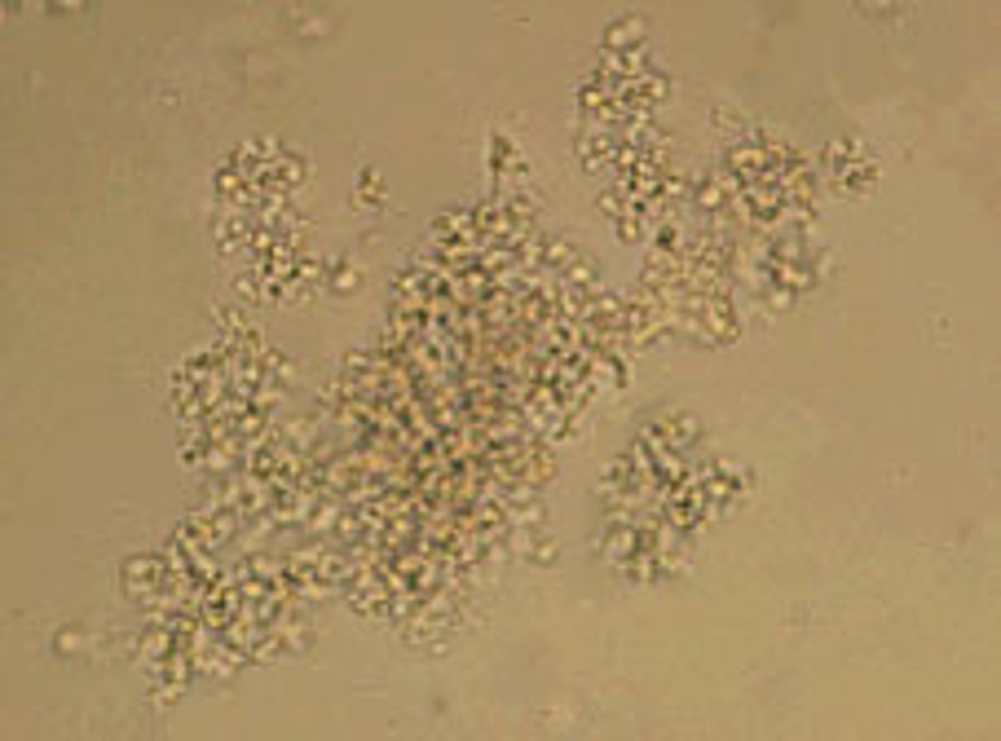 <p>Amorphous Urates</p>