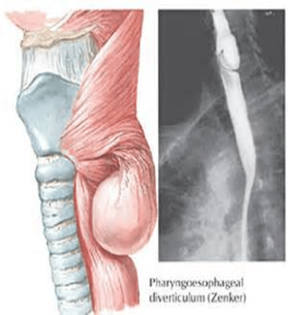 <p>Zenker's Diverticulum</p>