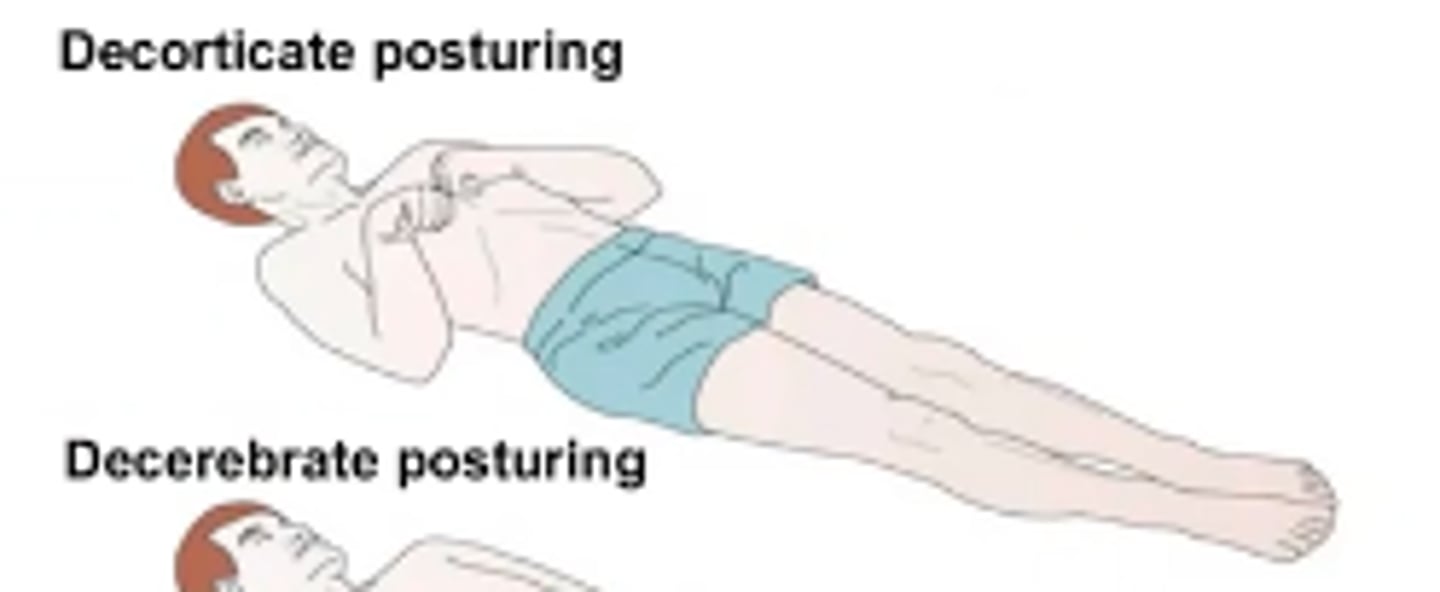 <p>Abnormal flexor response, sustained contraction and posturing of the UE in flexion &amp; LE in extension</p>