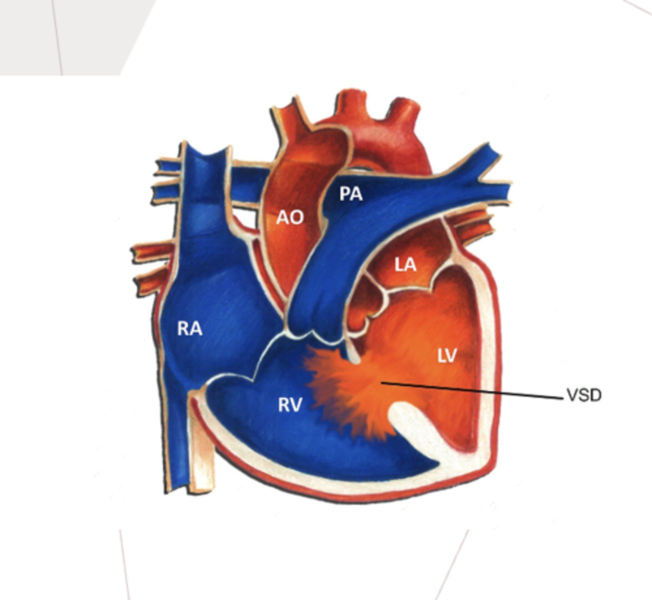 <p>a congenital, noncyanotic heart defect where the wall between the left and right ventricle is incompletely closed</p>