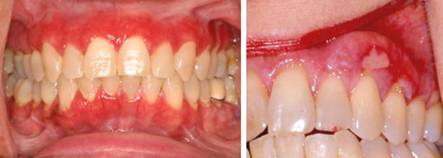 <p>PAINFUL</p><p>• red area surrounded by white striae</p><p>• shallow ulcers or desquamative gingivitis</p><p>• bilateral</p><p>• skin lesions</p><p>• common locations: buccal mucosa, gingiva, tongue</p><p>• population: middle-aged females</p>
