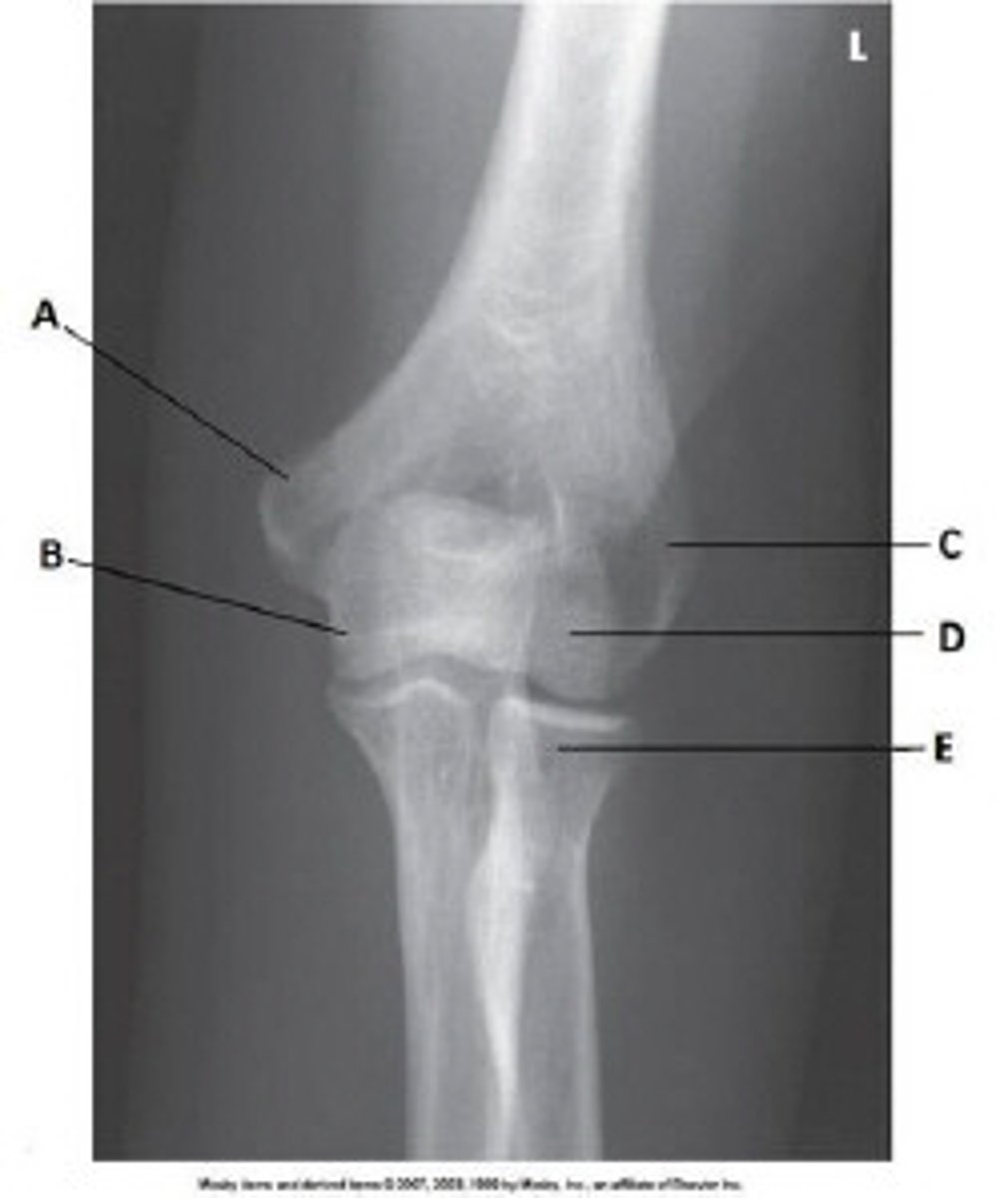 <p>What anatomy is labeled as letter D in the image below?</p><p>Lateral epicondyle of the humerus</p><p>Medial epicondyle of the humerus</p><p>Capitulum</p><p>Trochlea</p>
