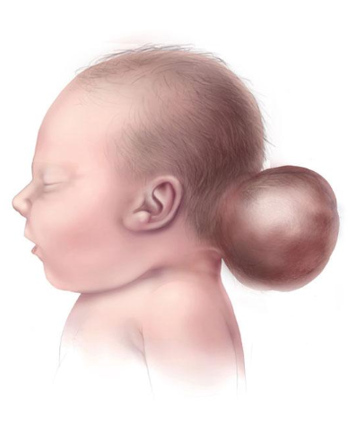 <ul><li><p>Primary error: <strong><mark data-color="yellow" style="background-color: yellow; color: inherit;">Failure of cranial neural tube closure and mesodermal skull formation</mark></strong></p></li><li><p class="p1">Timing: Weeks 3–4 of gestation</p></li><li><p class="p1">Result: Persistent cranial defect → protrusion of intracranial contents</p></li></ul><p></p>