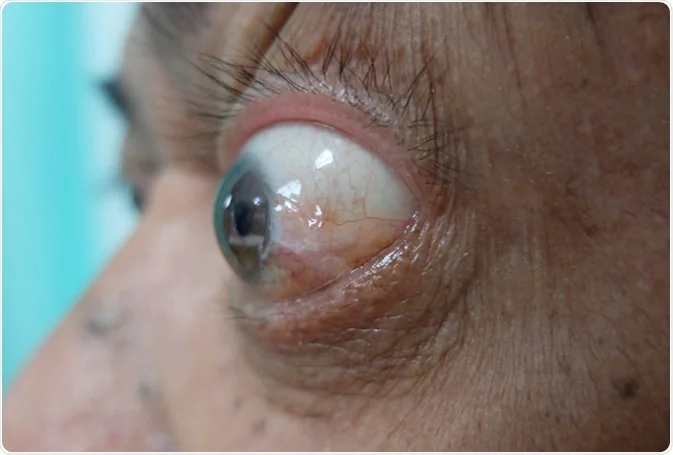 <p>term. exophthalmos </p>