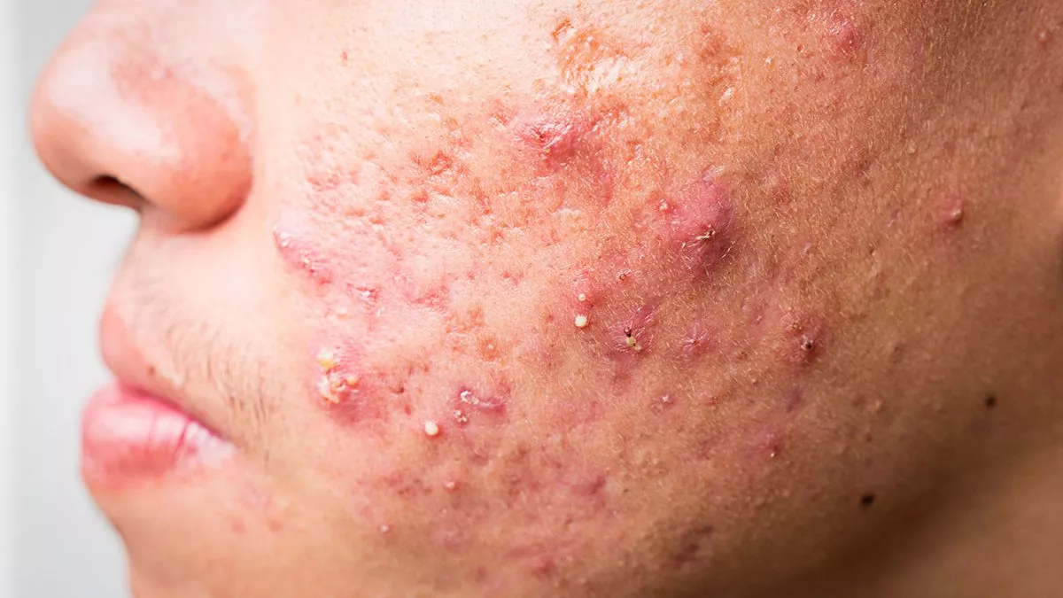 <p>Acne Vulgaris</p>