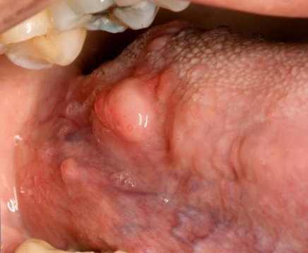 <p>enlargement of lymphoid tissue that appears yellowish</p>