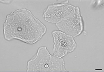 <p>Caused by shedding of the epithelium/urinary tract</p>