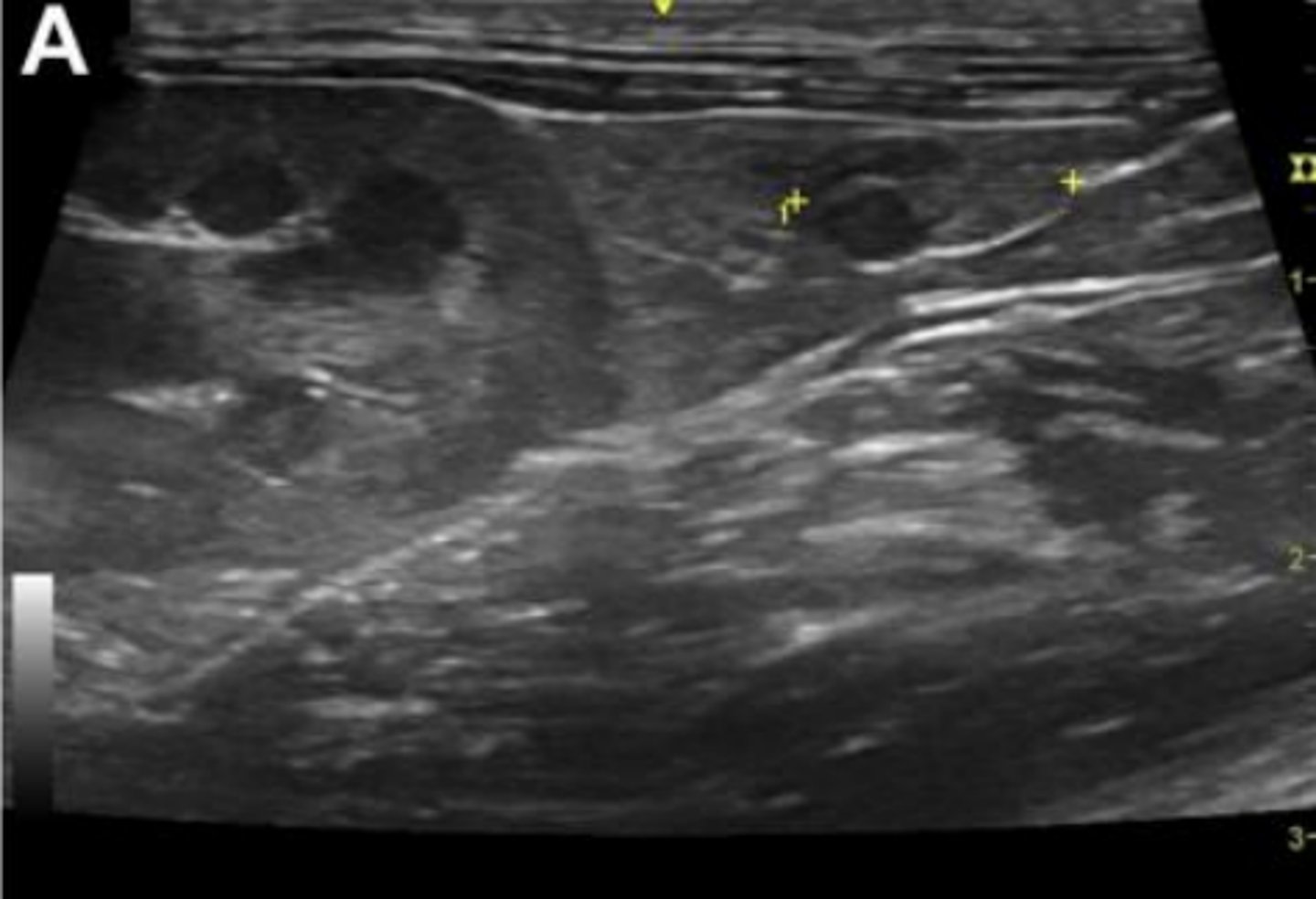 <p>What is seen in the left portion of the image that serves as the most consistent landmark for locating the ovary?</p>