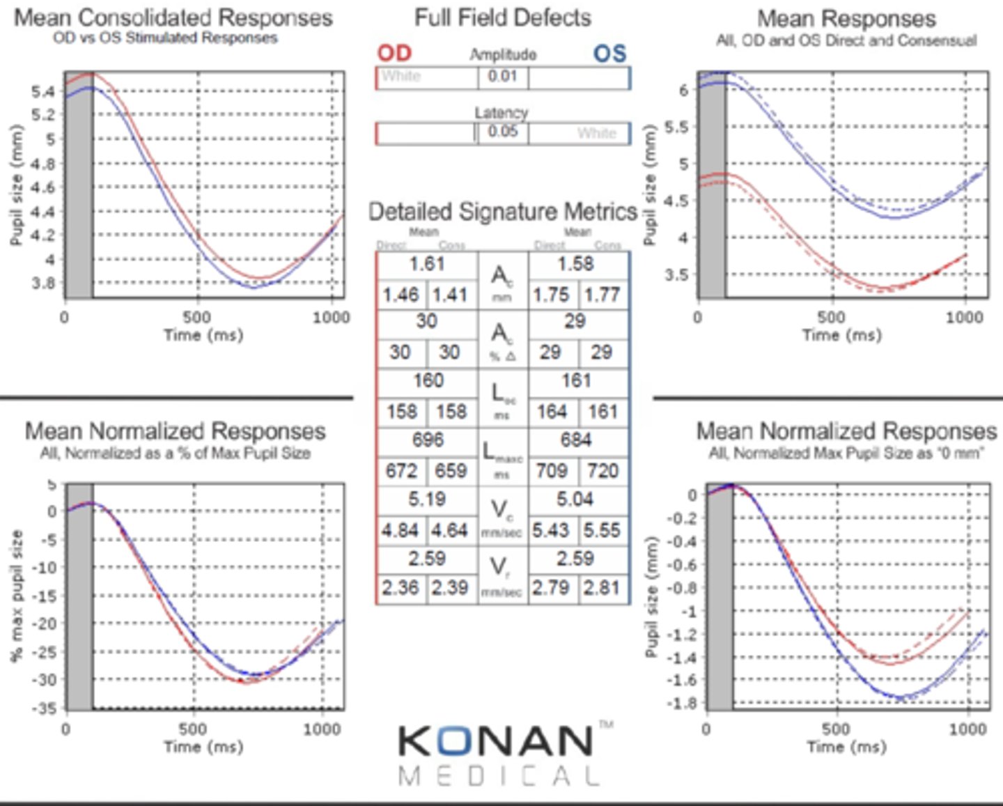 <p>slower redilation velocity (slope) in the OD = OD Horner's</p>