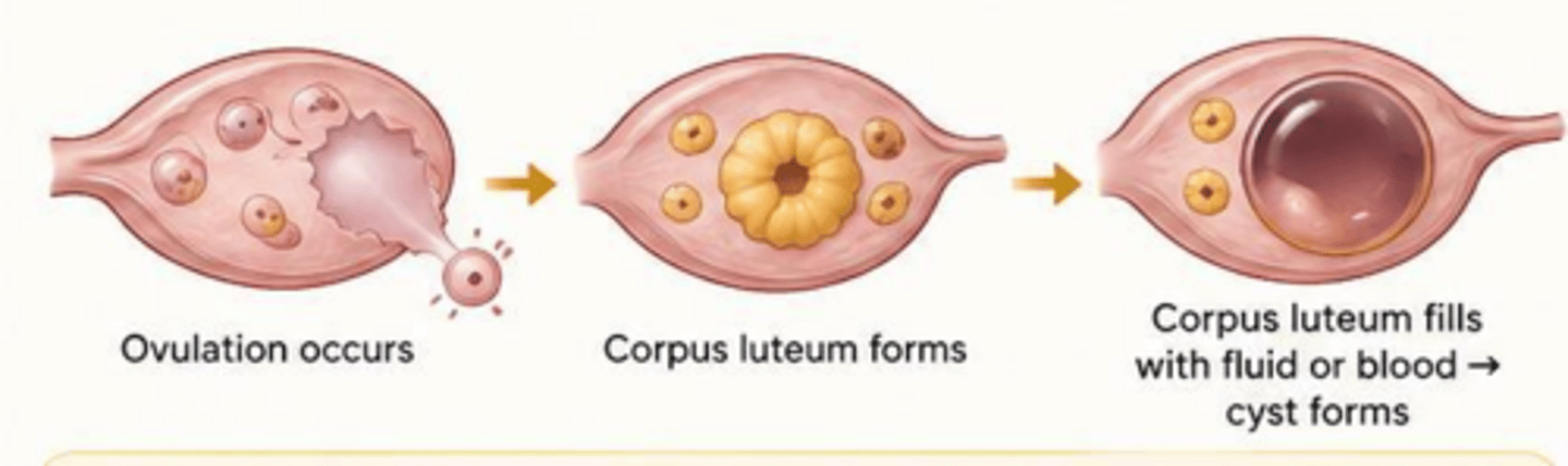 <p>Occurs when the corpus luteum fails to regress after ovulation and instead seals off, filling with blood or fluid.</p>
