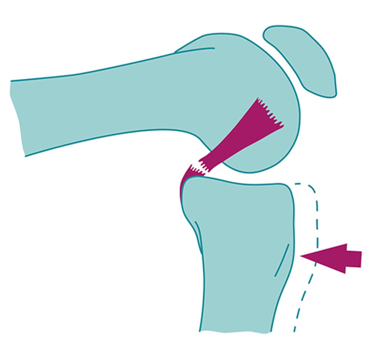 <p>PCL injury → knee immobilizer, crutches, RICE&lt; NSAIDs, PT</p><p>isolated PCL injuries are often treated nonoperatively</p>