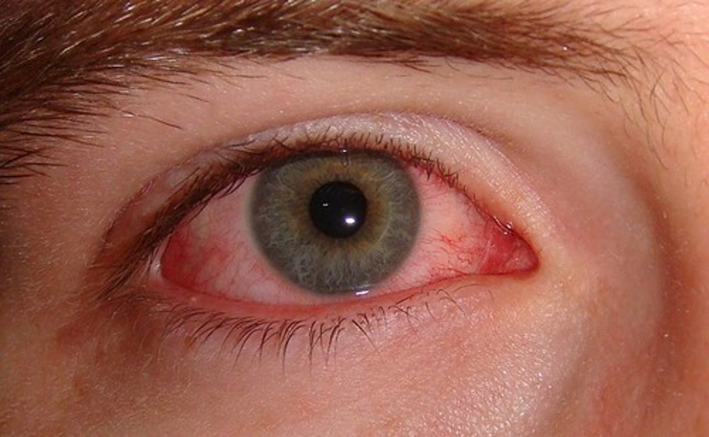 <p>pink eye, infection of conjunctiva</p>