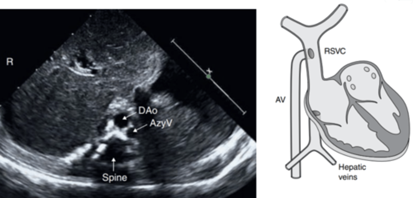 <p>IVC forms from the iliac veins, stops, then blood finds a way to the RA through the azygos/hemazygos vein</p>