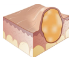 <p>Primary Skin Lesion</p><ul><li><p><strong>Semi-solid</strong> mass of skin and <strong>rubbery</strong> in texture</p></li><li><p>Mostly <strong>sacs</strong> containing <strong>fluids, air, etc</strong></p></li><li><p>E.g., epidermoid cyst</p></li><li><p>More <strong>superficial</strong> and evident</p></li><li><p>Will<strong> increase</strong> in size</p></li></ul><p></p>