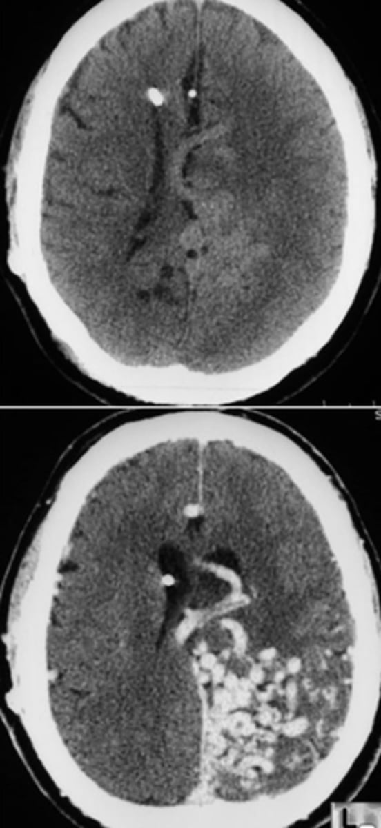 <p>a vascular malformation that is a tangle of abnormal blood vessels connecting arteries and veins in the brain</p><p>- can lead to hemorrhage</p><p>- surgical treatment</p>