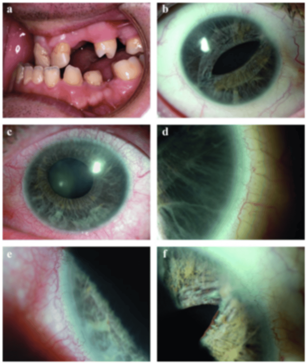 <p>Anterior segment of the eye</p>