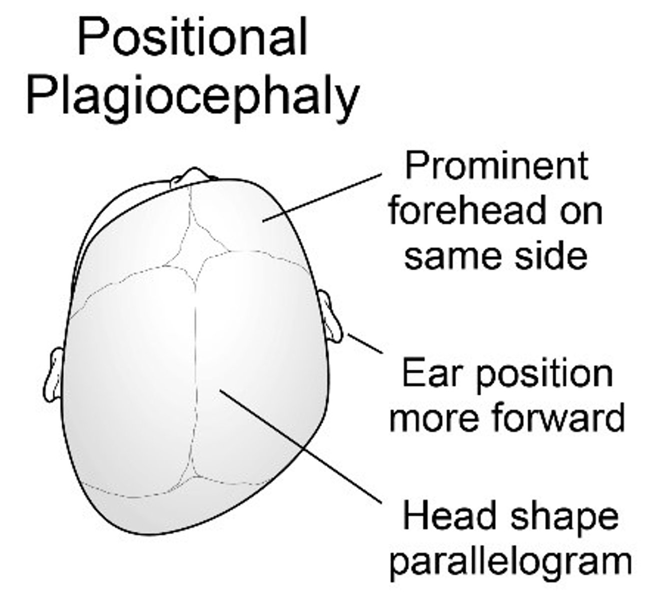 <p>Misshapen head</p><p>Usually from laying in one position</p><p>Flattening of occiput with a prominence of frontal region on opposite side</p>