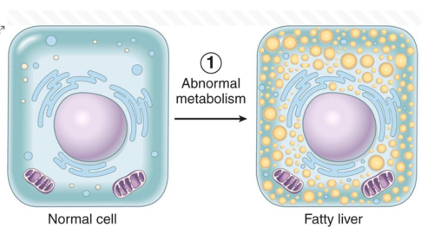 <p>It leads to steatosis (fatty degeneration).</p>