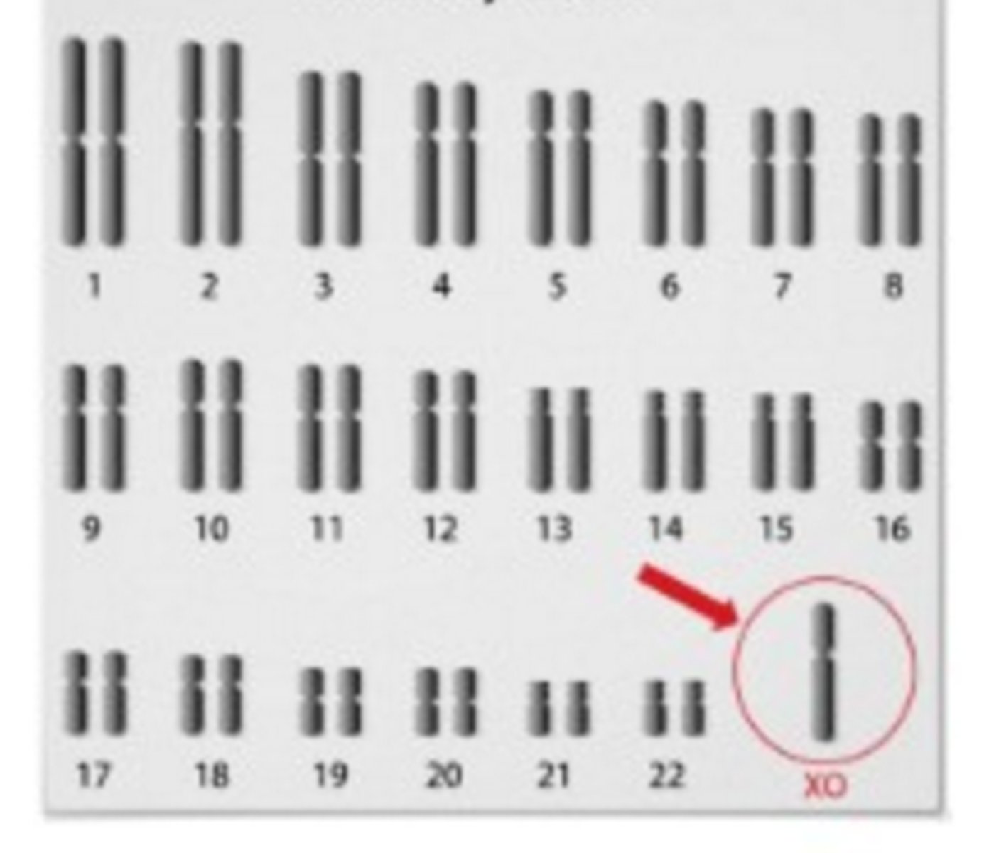<p>produces X0 females, who are sterile; it is the only known viable monosomy in humans</p>