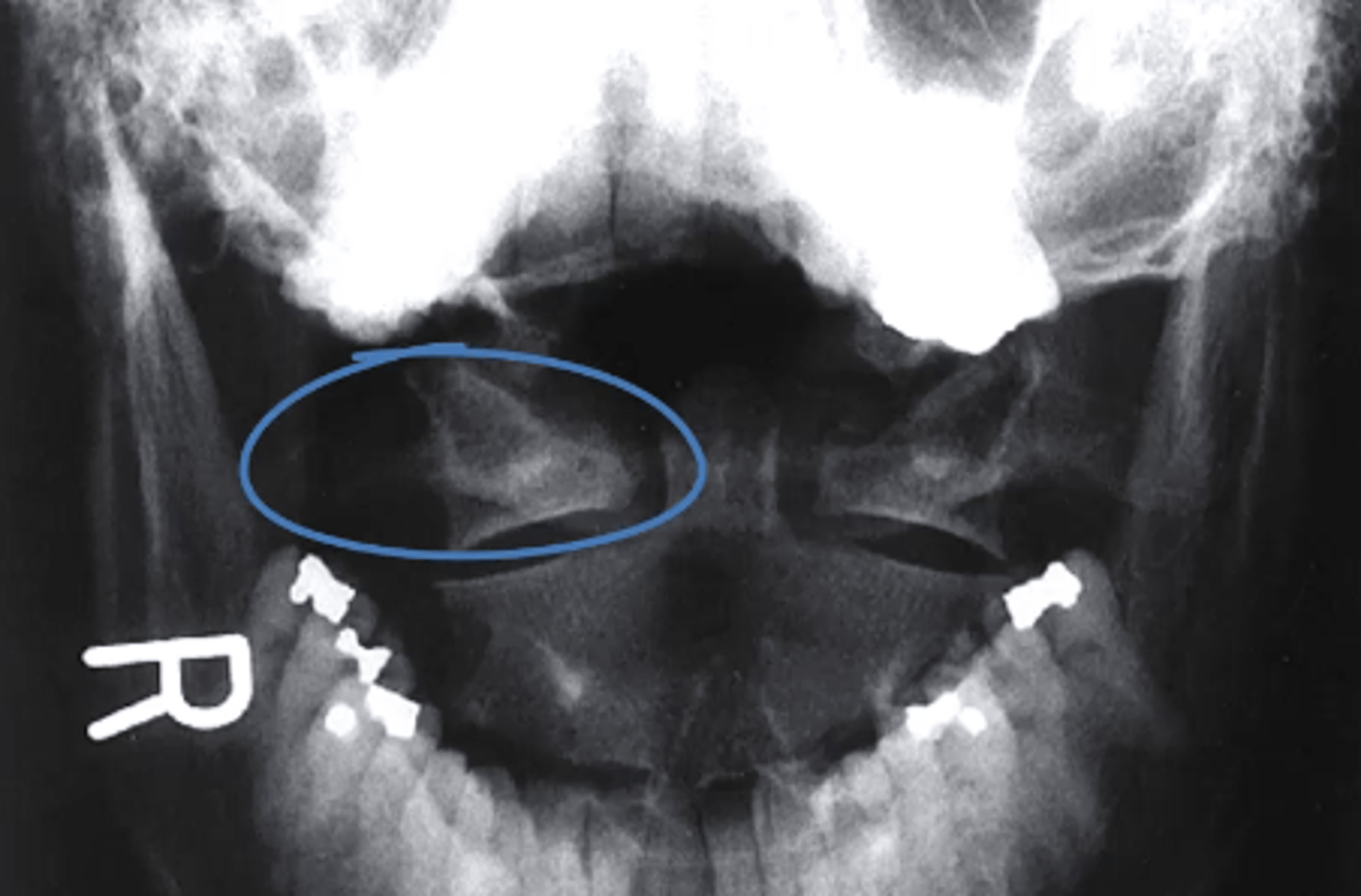 <p>what structure is circled in blue?</p><p>a. Dens</p><p>b. Lateral mass of the atlas</p><p>c. Body of C2</p><p>d. condylar process</p>