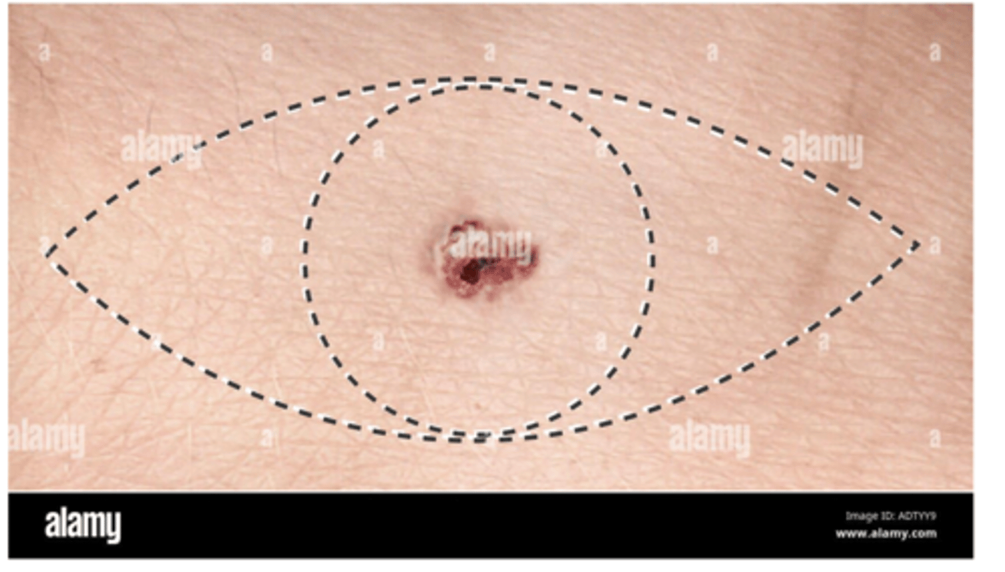 <p>excision with wide borders and sentinel lymph node biopsy</p><p>imiquimod</p><p>radiation</p><p>immune meds like PD-1 inhibitors, PD-L1 inhibitors, CTLA-4 inhibitors</p><p>gene targeted therapy drugs (e.g. BRAF protein inhibitors) to downregulate metastatic factors</p>