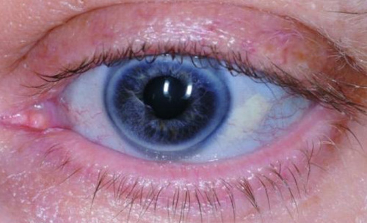 <p>Blue Sclerae - Translucent (visualize underlying choroid blood vessels)</p>