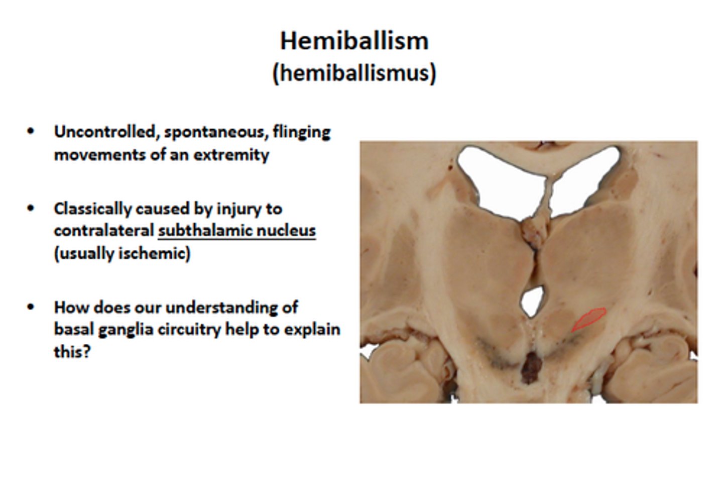 <p>An involuntary and violent movement of a large body part</p><p>Caused by a stroke in the subthalamus</p><p>Symptoms: violent, flinging movements of the contralateral arm and/or leg</p>