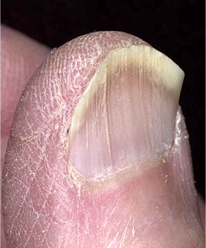 <p>spooning of nails; nail plate thins and becomes inverted due to poor perfusion to nails</p><p>ex: iron deficiency anemia</p>