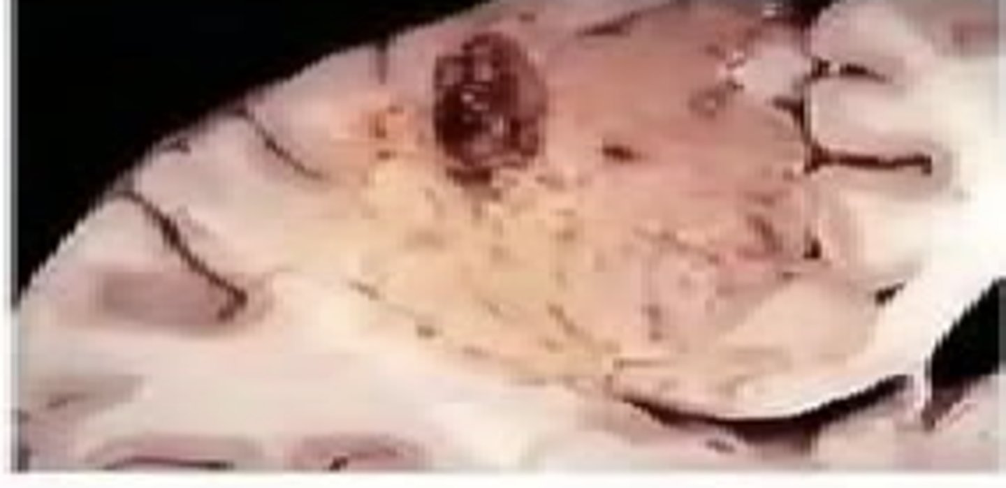 <p>Tissue completely digested → liquid/pus; caused by ischemia to the BRAIN or bacterial infections (wet gangrene)</p>