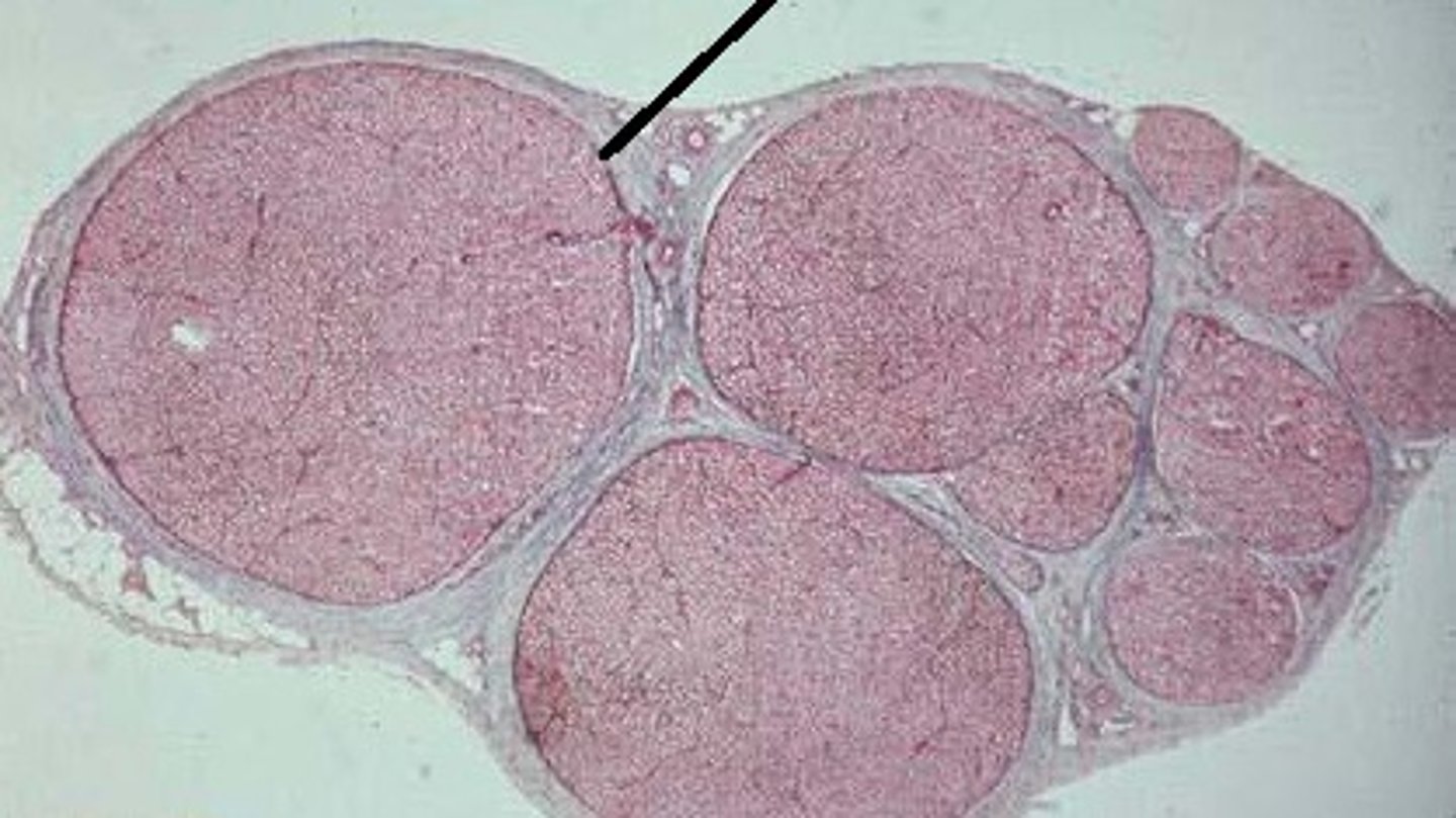 <p>coarse connective tissue that surrounds fascicles</p>