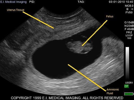 Ultrasounds create an image of internal body structures such as tendons, muscles, joints, blood vessels, and internal organs. The ultrasound pulses echo off tissues with different reflection properties and are returned to the probe, which records and displays them as an image. Ultrasounds are one of the few diagnostic imaging techniques that capture motion.