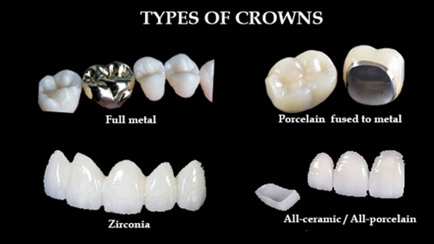 <p>What type of crown:</p><p>Indications:</p><p>- extensive coronal destruction by caries or trauma </p><p>- to support a partial removal dental prosthesis </p><p>- Endodontically Tx teeth </p><p>Contraindications: </p><p>- if a more conservative approach can be used </p><p>- high esthetics </p><p>- active caries/perio disease </p><p>Advantages:</p><p>- BEST retention</p><p>- BEST resistance </p><p>- BEST strength </p><p>Disadvantages:</p><p>- not esthetic </p><p>- adverse effect on pulp &amp; periodontium</p><p>- cannot perform EPT on vital tooth </p><p>**Type of Preparation:**</p><p>CHAMFER bur all the way around </p><p>- Axially= 0.8-1mm </p><p>- Occlusally/Incisial= 1-1.5mm</p><p>Cement:</p><p>- Anything EXCEPT Light cure resin </p><p>- RelyX Unicem or RelyX Luting Plus</p>