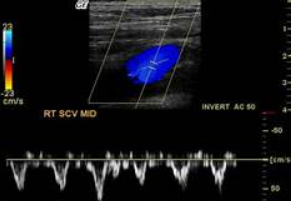 <p>This is a normal subclavian waveform. </p>