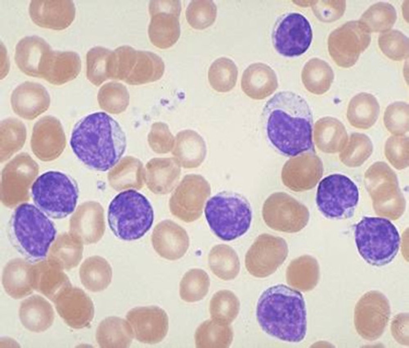 <p>Cancers of the hematopoietic stem cells in the bone marrow</p>