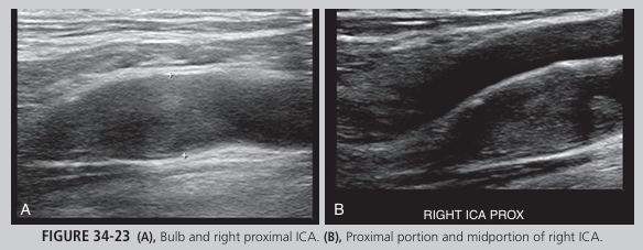 <p>A 67-year-old man is taken to the hospital via ambulance. His symptoms include confusion, loss of memory, aphasia, and left sided hemiparesis. His history includes hypertension, hypercholes terolemia, and smoking. A carotid sonogram revealed echogenic material within the right internal carotid lumen. Images are pro vided in Figure 34-23. No flow was seen with spectral Doppler. What do these findings indicate?</p>
