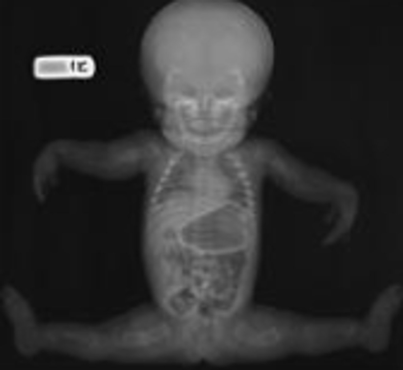 <p>skeletal dysplasias</p><p>new</p><p>lethal</p>